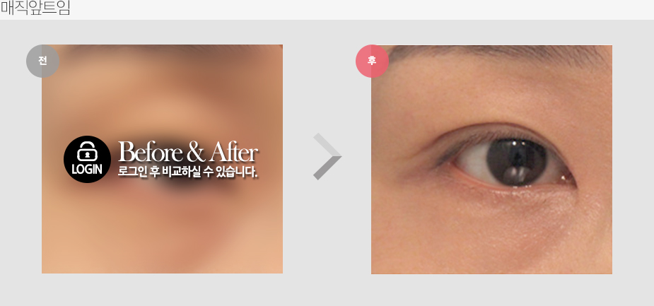 Before $ After