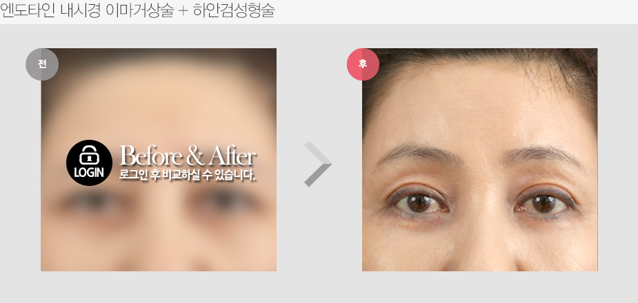 Before & After