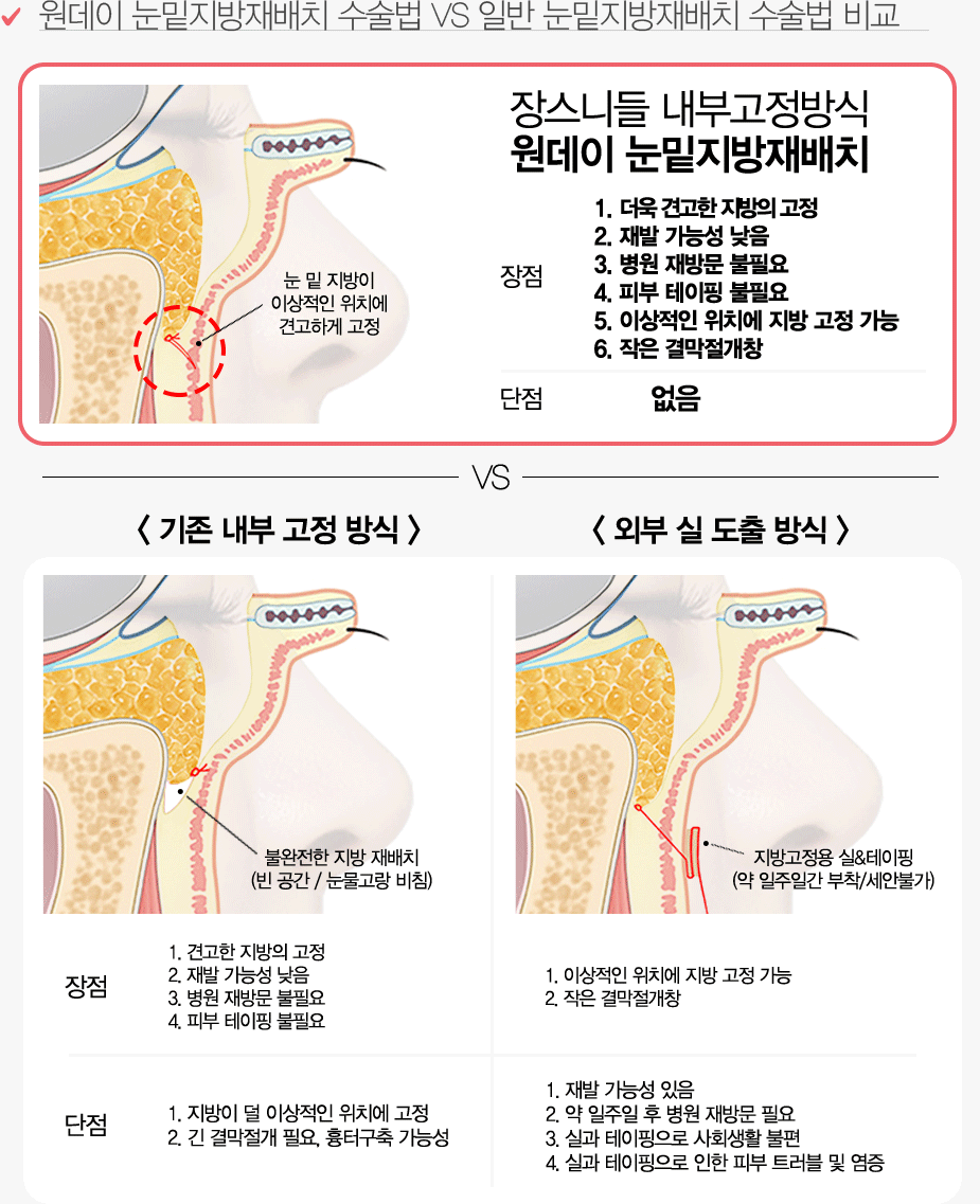 기존의 눈밑지방재배치 수술 비교