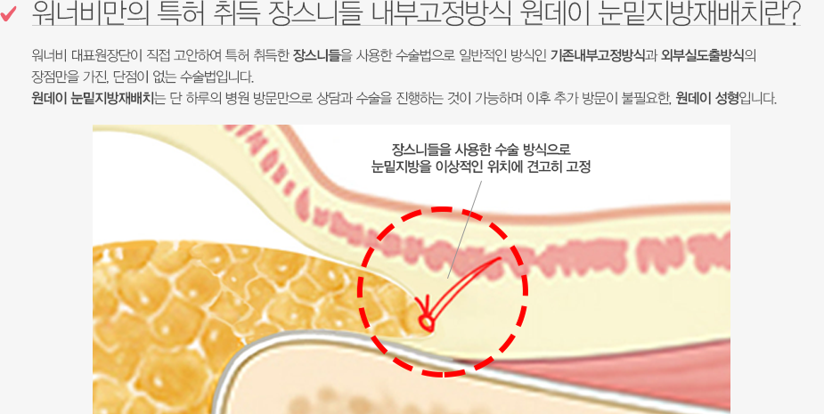 워너비만이 가능한 내측 고정 눈밑지방재배치란