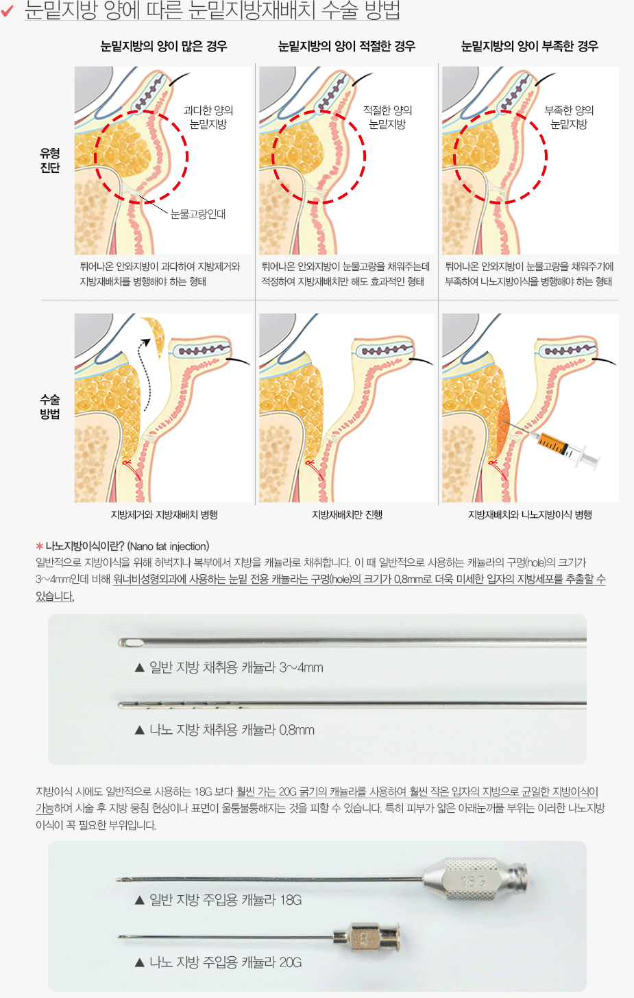 눈밑지방 양에 따른 눈밑지방재배치 수술 방법