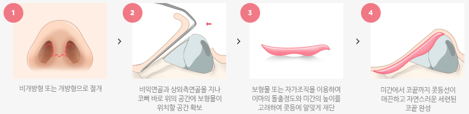 낮은콧등 수술방법