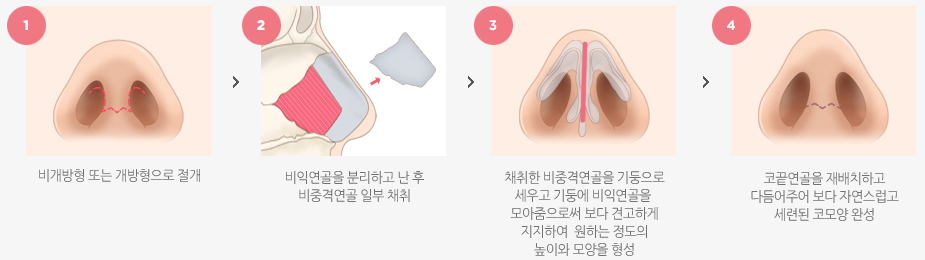 낮은코끝 수술방법