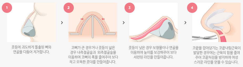 매부리코 수술방법