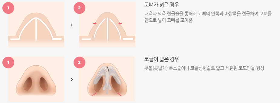 넓은콧등 수술방법