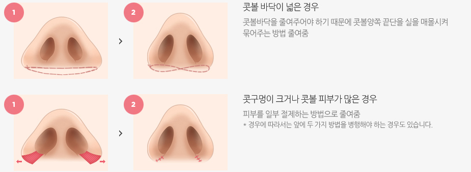 콧볼성형 수술방법