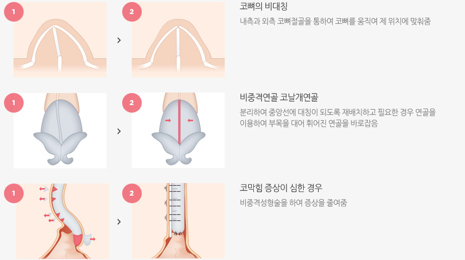 휜코성형 수술방법