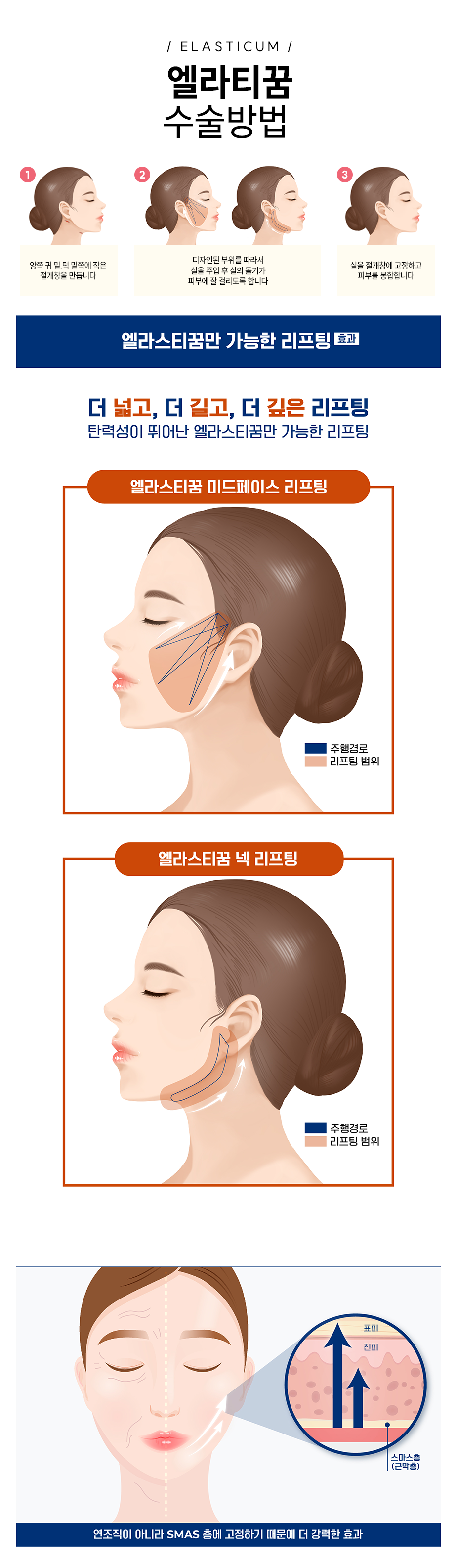 엘라스티꿈 수술방법 - 1.양쪽 귀 밑, 턱 밑쪽에 작은 절개창을 만듭니다. 2.디자인된 부위를 따라서 실을 주입 후 실의 돌기가 피부에 잘 걸리도록 합니다. 3.실을 절개창에 고정하고 피부를 봉합합니다.