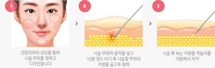 아큐 리프팅 수술방법