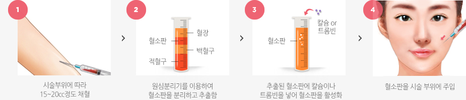 PRP 피부재생 클리닉 수술방법
