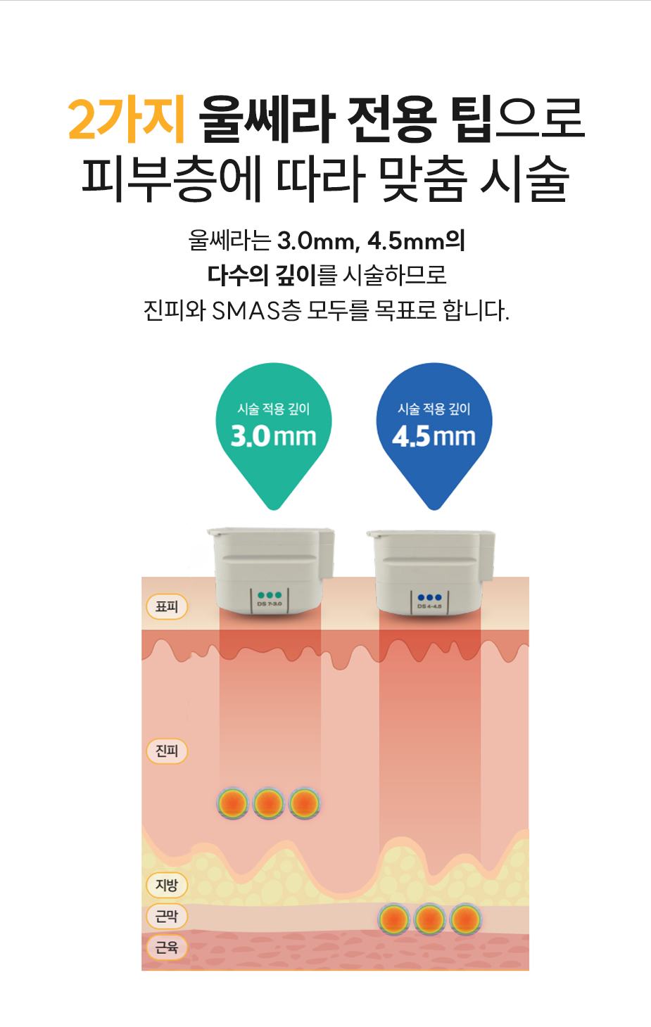 3가지 울쎄라 전용 팁 - 피부층에 따라 맞춤 시술