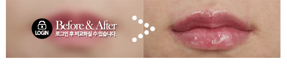Before $ After
