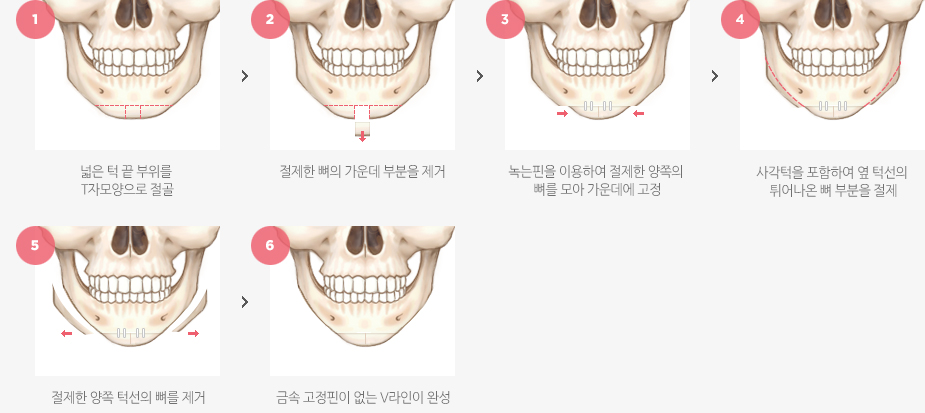 시크릿V라인 수술방법