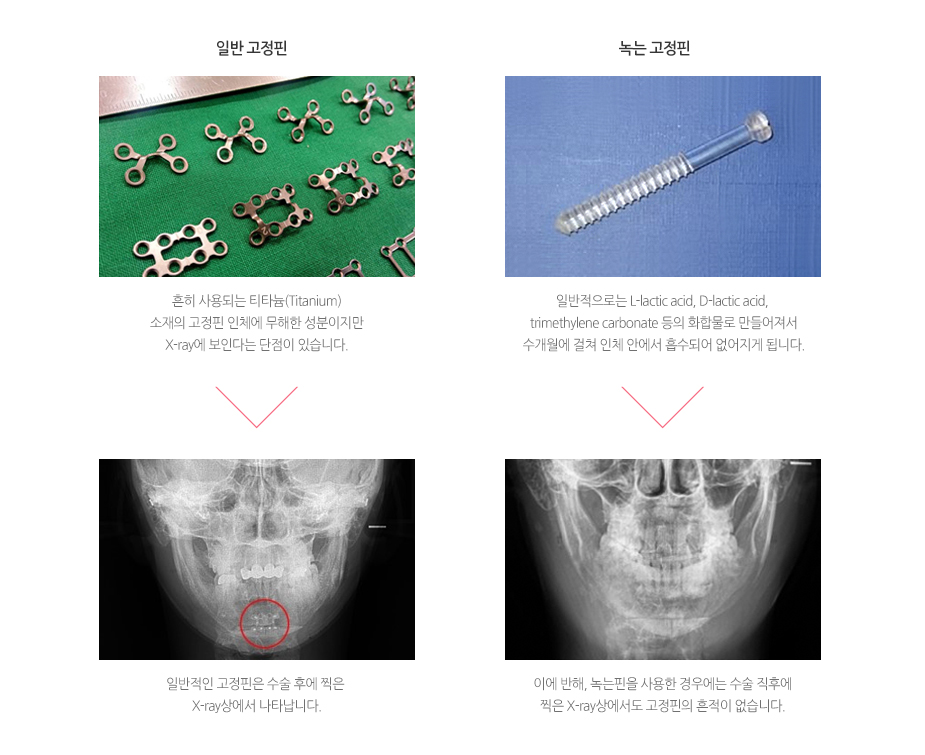 일반 고정핀 VS 녹는 고정핀 비교