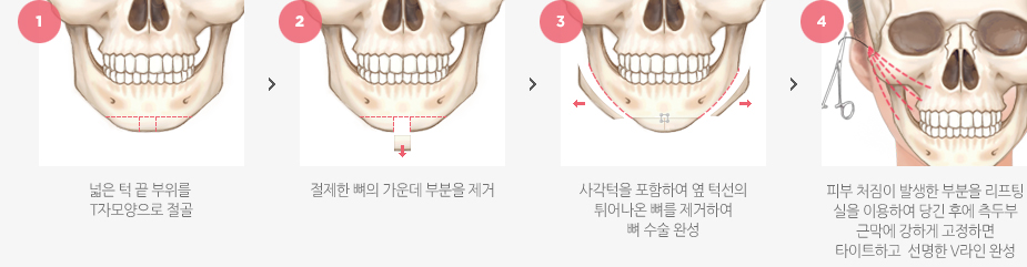 리프팅V라인 수술방법