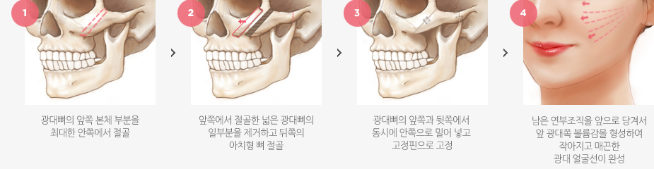 워너비광대 수술방법