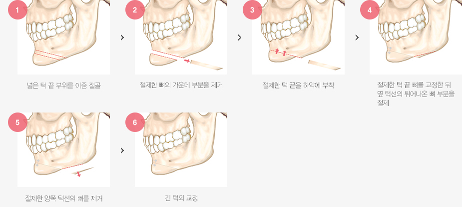 긴턱수술 수술방법