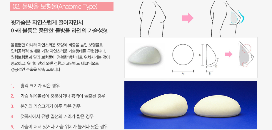 물방울보형물과 원형보형물 특징-원형보형물