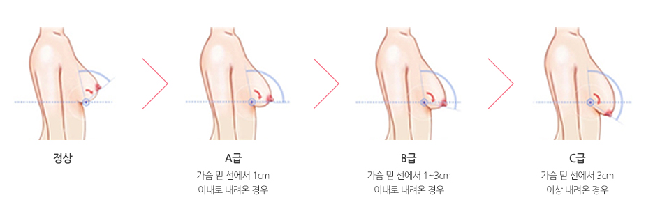 가슴처짐의 정도