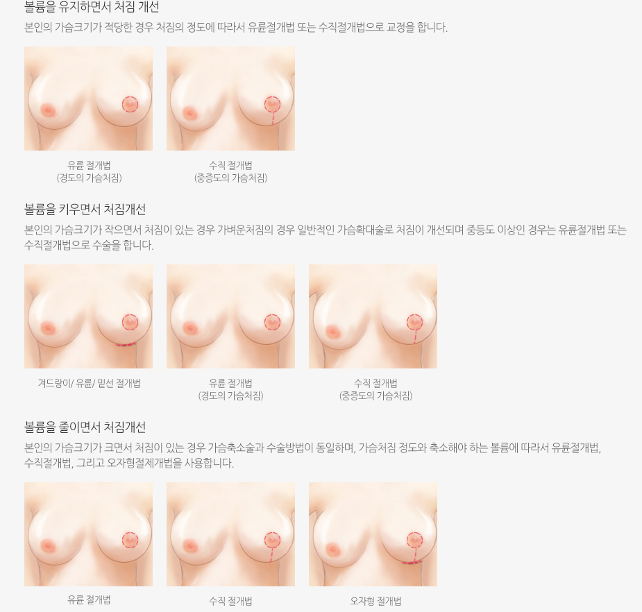 가슴처짐 교정술 수술방법