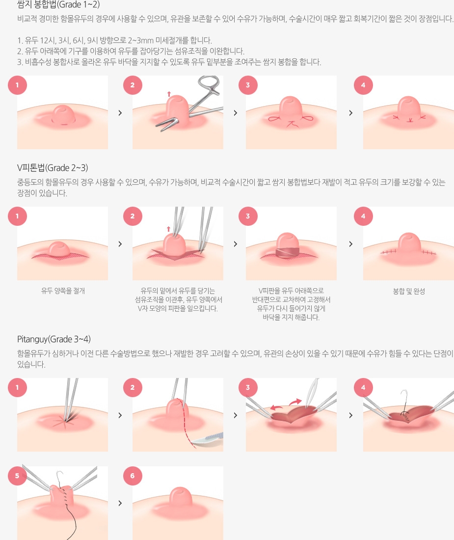 함몰유두교정술 수술방법